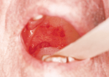 健康・医学 Differential Diagnosis of Oral Lesions Differential Diagnosis of Oral and Maxillofacial Lesions